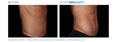 booty sculpting san antonio|EMSCULPT Booty Lift .